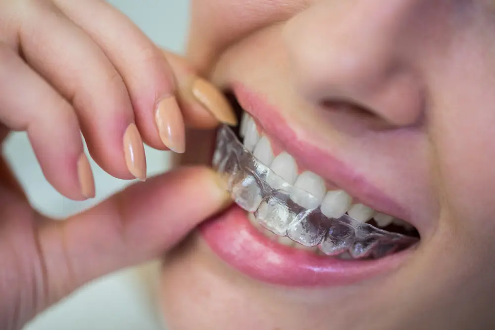 Invisible Aligners